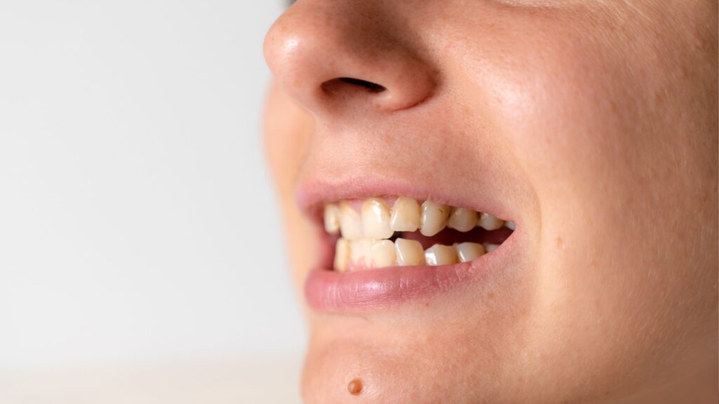Çarpık Diş Tedavisi İçin Şeffaf Plak Tedavisi